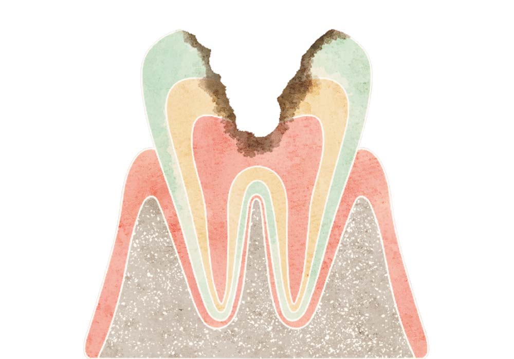 神経まで進行したむし歯（C3）