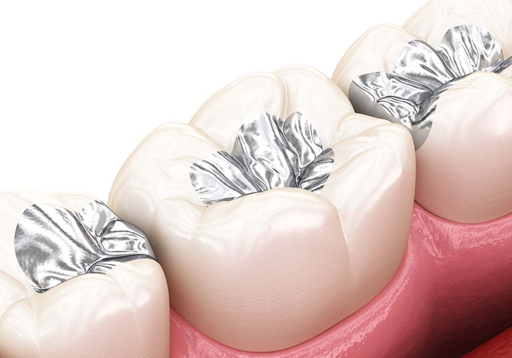 銀色の詰め物・被せ物（銀歯）