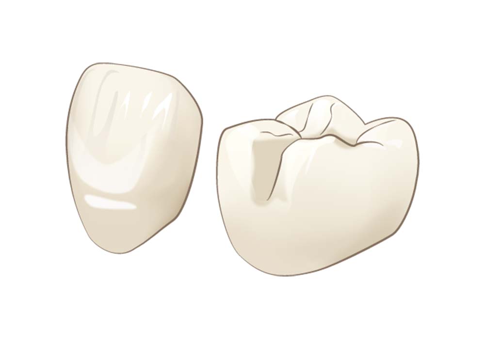 セラミックの詰め物・被せ物